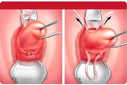 incompetenta cervicala (istmica-cervicală) incompetenta cervicala