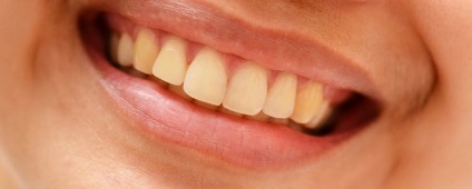 Cum de a elimina ingalbenirea dintilor (clinica dentara) Cum de a elimina îngălbenirea dinților