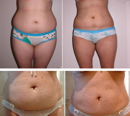 Cum de a elimina grasimea de pe abdomen și părțile laterale liposatsiya și lipoliza, tehnici hardware cosmetologie (laterale) Cum de a elimina grasimea de pe abdomen și părțile laterale liposatsiya și lipoliza, tehnici hardware cosmetologie