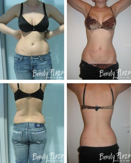 Cum de a elimina grasimea de pe abdomen și părțile laterale liposatsiya și lipoliza, metode hardware cosmetologie (eliminați) Cum de a elimina grasimea de pe abdomen și părțile laterale liposatsiya și lipoliza, tehnici hardware cosmetologie