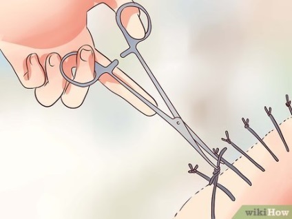Cum de a recupera de la liposuctie (liposuctie) Cum de a recupera de la liposuctie