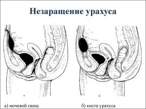 Chist descriere urahusa, cauze, simptome și tratament (simptome) Chist descriere urahusa, cauze, simptome si tratamente