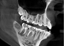 Tomografia computerizata dinți (dinți de tomografie computerizata) dinti tomografie computerizata