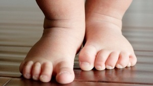 PVE la copii dobândite și tratamentul de picior stramb congenital picior stramb, tencuieli la (picior strâmb) PVE la copii dobândite și tratamentul de picior stramb congenital picior stramb, tencuieli cu