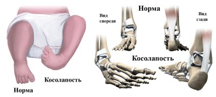 PVE la copii dobândite și tratamentul de picior stramb congenital picior stramb, tencuieli la (picior strâmb) PVE la copii dobândite și tratamentul de picior stramb congenital picior stramb, tencuieli cu