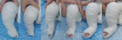 PVE la copii dobândite și tratamentul de picior stramb congenital picior stramb, tencuieli cu (dobândite) PVE la copii dobândite și tratamentul de picior stramb congenital picior stramb, tencuieli cu