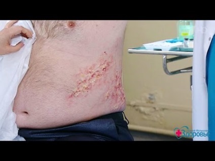 erupții cutanate (vezicule, pete roșii) pe corpul tipuri de erupții cutanate (erupții cutanate) erupții cutanate (vezicule, pete roșii) pe corpul tipuri de erupții cutanate