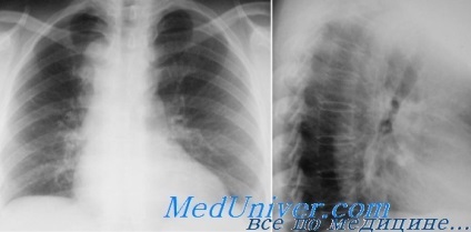 artera pulmonara si aorta pe radiografia toracică (pulmonară) artera pulmonara si aorta pe radiografia toracică