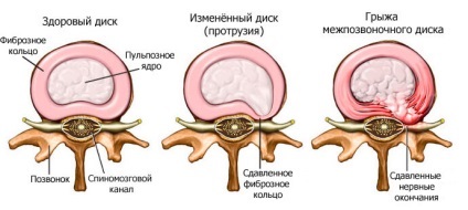 Discurile herniate ale tratamentului lombare și îndepărtarea, simptomele unei hernie de disc (lombare) Discurile herniate ale tratamentului lombare și îndepărtarea, simptomele unei hernie de disc