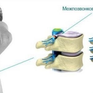Discurile herniate ale tratamentului lombare și îndepărtarea, simptomele unei hernie de disc (tratament) Discurile herniate ale tratamentului lombare și îndepărtarea, simptomele unei hernie de disc