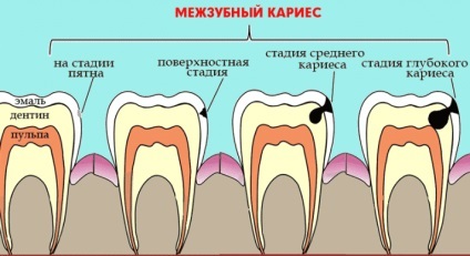 Interproximală carie tratament, simptome, prevenirea cariilor dentare și provoacă între dinți (dinți) Interproximală carie tratament, simptome, prevenirea cariilor dentare și provoacă între dinți