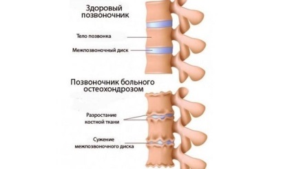 Osteocondrozei a coloanei vertebrale lombare - simptome si tratament (coloanei vertebrale) Osteocondrozei a coloanei vertebrale lombare - simptome și tratament