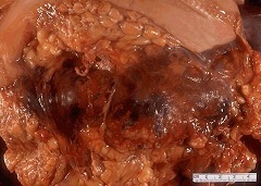 Pancreonecroza pancreas - tratament operație (chirurgie pancreatice) Pancreonecroza pancreas - operație, tratament
