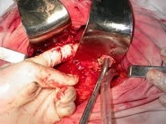 Pancreonecroza pancreas - tratament operație (intervenție chirurgicală) Pancreonecroza pancreas - operație, tratament