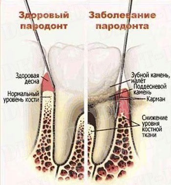 Parodontită - simptome și cauzele problemelor orale (cauze) Parodontita - simptome si cauze de probleme orale