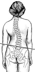 Nealiniere (offset) a bazinului (offset) Nealiniere (offset) a oaselor pelvine