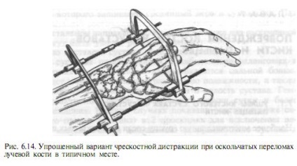 Fractura radiusului distal - chirurgie și tratament (osoase) Fractura radiusului distal - chirurgie și tratament
