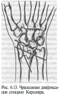 Fractura radiusului distal - chirurgie si tratament (radioterapie) Fractura radiusului distal - chirurgie și tratament