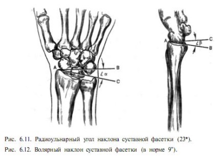 Fractura radiusului distal - chirurgie și tratament (fractură) Fractura radiusului distal - chirurgie și tratament