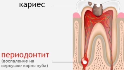 Parodontită - Simptome si tratament (tratament parodontitei) Parodontita - Simptome si tratament