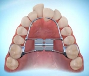 Plăci de aliniere dinți, aviz expert (defecte dentiția) Placi de aliniere dinți, aviz expert