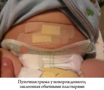 Ipsos de hernie ombilicală sunt folosite specii pentru copii (plasture) Ipsos de hernie ombilicală Species Baby, modul de utilizare