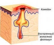 De ce nu formează ulei de comedoane - scurgeri și - blocat - în porii (ocluzie a glandelor sebacee) De ce nu formează ulei de comedoane - scurgeri și - blocat - în porii