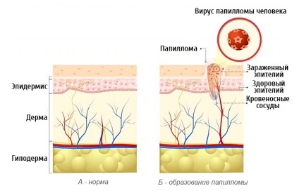 De ce am papilomavirus (de ce) De ce am papiloma