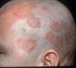 Motivele pentru apariția simptomelor și moduri de a trata erupții cutanate pe mâini (tratament) Motivele pentru apariția simptomelor și moduri de a trata erupții cutanate pe mâini