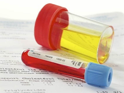Cauzele prostatita (apariție) Cauzele prostatita