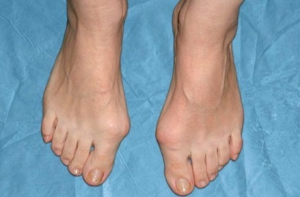 Natura cauze de oprire valgus, tratament (valgus) valgus Natura opri cauze, tratament
