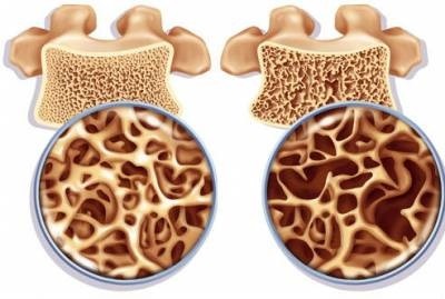 Prevenirea osteoporoza medicamente, dieta si stilul de viata (osteoporoza) Prevenirea osteoporoza medicamente, dieta și stilul de viață