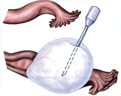 Puncția ovarian pregătire chisturi, contraindicații, comportament și consecințele (ovar) Puncția chisturi ovariene de pregătire, contraindicații, comportament și consecințele