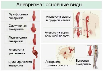 Expansiunea vasului de sânge (anevrism) tipuri, simptome, cauze, efecte și tratamente (simptome) Expansiunea vasului de sange tipuri, simptome, cauze, efecte (anevrism) si tratamente
