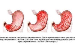 Acid Vărsături (acid) Acid vărsături