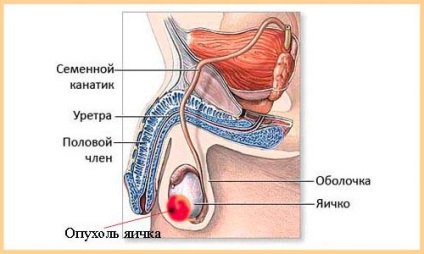 simptome seminom testicular, stadiu, prognosticul (seminom) simptome seminom testicular, etapa, prognostic