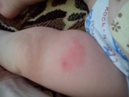 Cone după DTP (umflătură) Bump după DTP