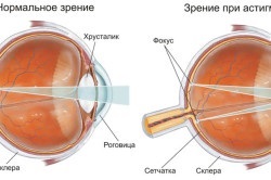 Simptomele de astigmatism (globului ocular) simptome de astigmatism
