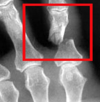 Simptomele de fractură (dislocarea fractură a cartilajelor laringian) simptome fracturi