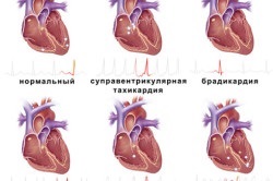 ritm sinusal (prima a inimii) ritm sinusal