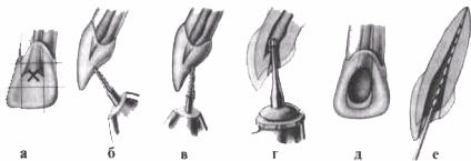 Sky - endodonție clinice (schema maxilo) Sky - endodonție clinice