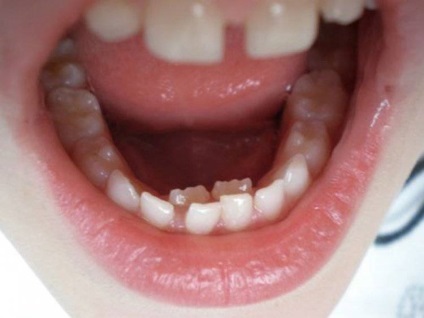 Conditii de dentiției la copii comanda de schimbare, o masă de grafică, precum și legate (erupției dinților permanenți în tabelul pentru copii) Conditii de dentiției la copii comanda de schimbare, o masă de grafică, precum și conexe