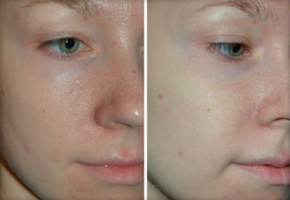 Thiogamma ridurilor faciale cosmetologi comentarii și pacienți (Thiogamma) Thiogamma ridurilor faciale cosmetologi comentarii și pacienți