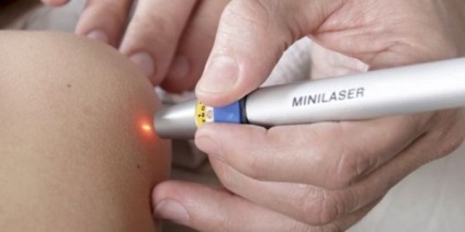 Eliminarea condiloame Detalii Procedura cu laser (procedură) Eliminarea procedurilor de veruci cu laser Detalii