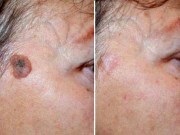 Îndepărtarea cu laser a verucilor (Îndepărtarea cu laser a verucilor papilom cu laser elimina papilloma după alunițe de îndepărtare în cazul în care tratamentul cu laser papilloma cauterizare cu laser HPV imagine video îndepărtată și îndepărtați pot fi îndepărtate ca îndepărtat dacă dureros ardere moli imposibil) Îndepărtarea cu laser papiloamelor