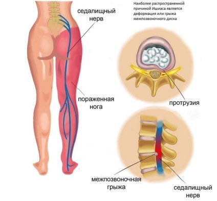 Împușcat în nervul sciatic efectelor ce să facă în caz de avarie (consecințe) Împușcat în nervul sciatic efectelor ce să facă în caz de avarie