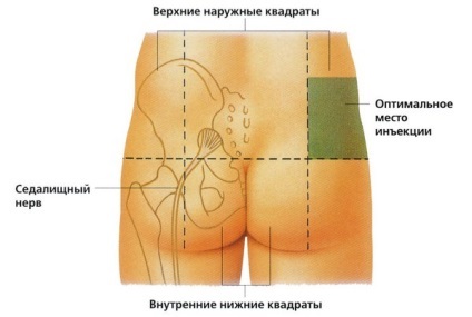 Împușcat în nervul sciatic efectelor ce să facă în caz de avarie (împușcat) Împușcat în nervul sciatic efectelor ce să facă în caz de avarie