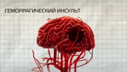 Tipuri de accident vascular cerebral cerebrale și diferența lor (specii) Tipuri de accident vascular cerebral cerebrale și diferențele lor