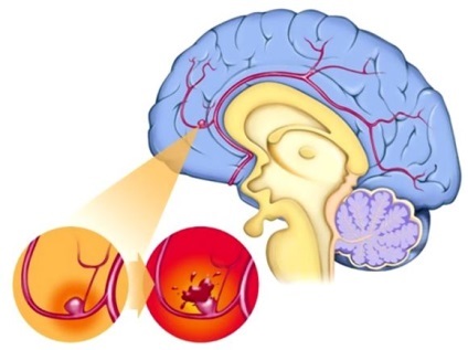 Tipuri de accident vascular cerebral cerebrale și diferențele lor