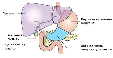 Tipuri de operații pentru cancerul gastric (tipuri) Tipuri de operații pentru cancerul gastric